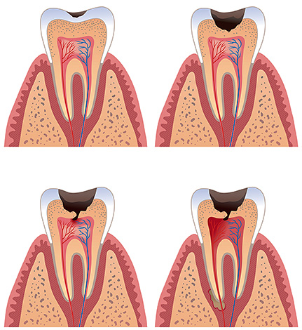 Pain can begin when the carious process reaches the dentin, and especially the pulp.