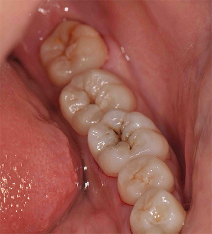 Often, fissure caries is easy to detect already with a simple visual inspection of the teeth.