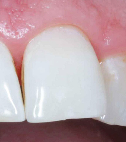 Y así es como se ve un diente después del tratamiento con ICON.