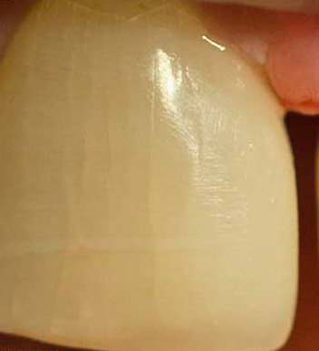 बहुत गर्म और ठंडे उत्पाद दांत तामचीनी में माइक्रोक्रैक्स की उपस्थिति में योगदान देते हैं।