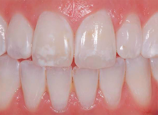 В някои случаи домашното използване на флуорид паста за зъби може да бъде вредно, например, с флуороза (на зъбите се появяват бели петна поради излишък на този елемент в тялото).