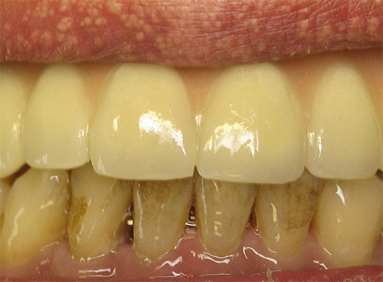 Gele tanden van de roker