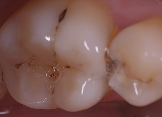 진한 색소의 에나멜은 치과 의사 에게서만 제거 할 수 있으며 치아 충전으로 이어질 수 있습니다.