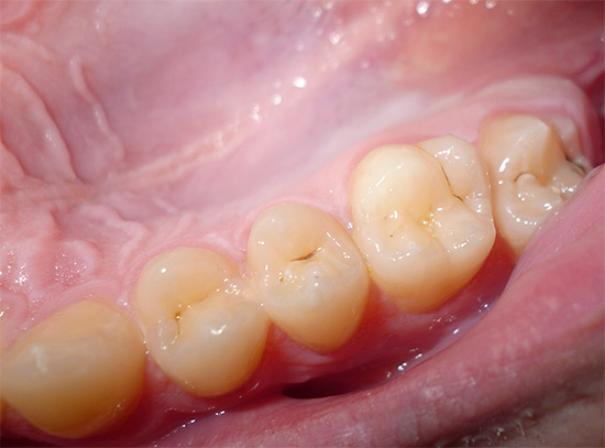 Das Foto zeigt typische kariöse Brauen im Fissurenbereich des Zahnes - es ist fast unmöglich, sie zu Hause zu entfernen.
