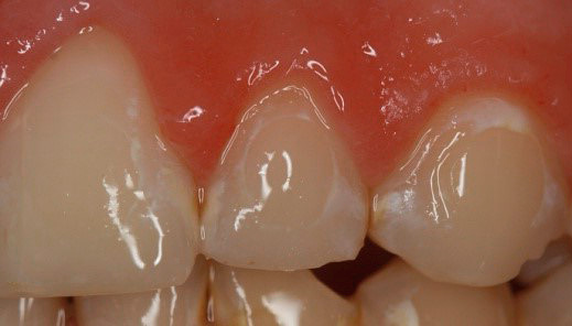 Và ở đây được thể hiện sâu răng trong giai đoạn đầu của cái gọi là đốm trắng, vì vậy bạn có thể tự mình chiến đấu.