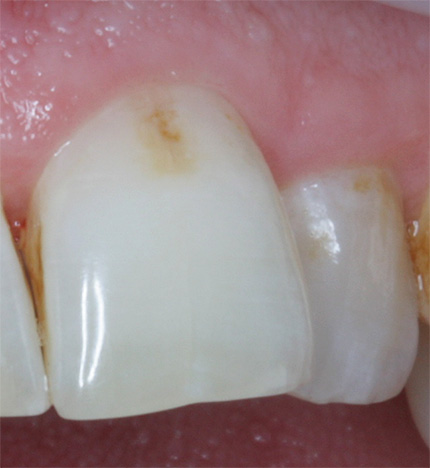 Fotografia prezintă un exemplu de dinte cu carii inițiale înainte de tratament.