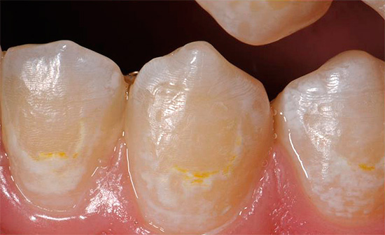 사진은 초기 충치의 예를 보여줍니다. 치아 에나멜이 흰색으로 바뀌고 색소가 나타납니다.