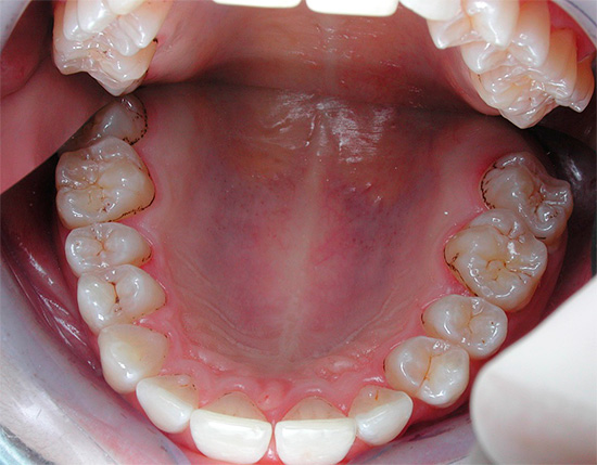 การปรากฏตัวของกากอาหารในช่องปากเป็นเวลานานทำให้เกิดแบคทีเรีย cariogenic ที่ดีเยี่ยม