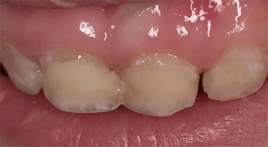 Cần thực hiện các biện pháp bảo vệ sâu răng khỏi sự xuất hiện của chiếc răng bé đầu tiên, mà không cần chờ đợi sự hủy diệt của nó bắt đầu ...