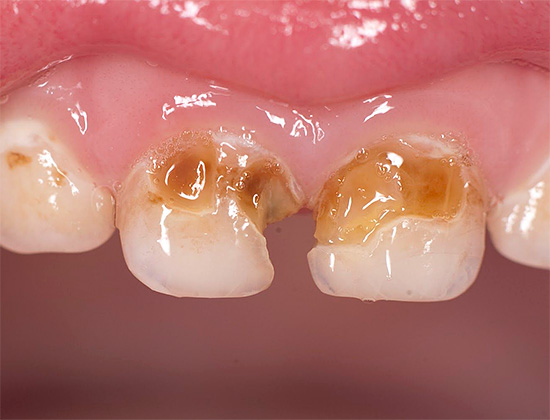 Начините за защита на зъбите, които се считат за по-нататъшни, ще бъдат особено полезни за тези, които вече имат кариозни лезии и които искат да спрат развитието си.