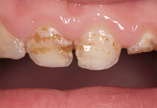 При лоша устна хигиена зъбният емайл може да бъде унищожен в някои случаи много бързо, особено в зъбите на млякото.