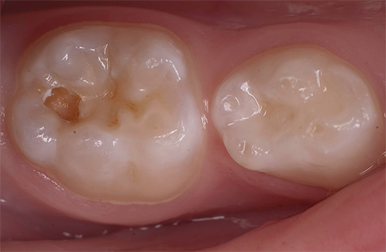 Μετά την καταστροφή της τεμαχιδής του σμάλτου επεκτείνεται στην οδοντίνη του δοντιού και η διάγνωση της παθολογίας και η επακόλουθη θεραπεία σε αυτό το στάδιο έχουν τα δικά τους χαρακτηριστικά ...