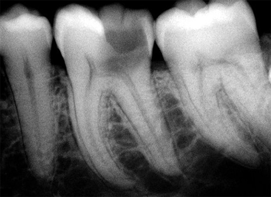 Radiografía de un diente enfermo: está claro que la dentina y la pulpa están afectadas.