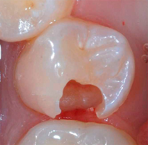 Photograph of the tooth before treatment