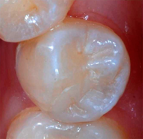 And this is a photo of a tooth with an already installed seal