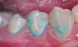 Η συνεχής χρώση του σμάλτου των δοντιών με κυανό του μεθυλενίου δείχνει την έναρξη της αφαλάτωσης