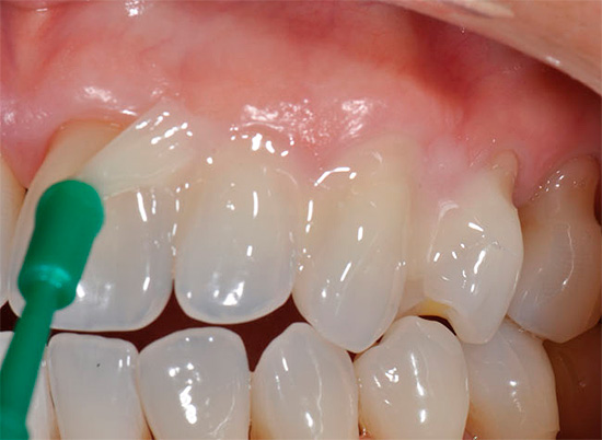 Thủ tục tái khoáng thường xuyên làm giảm đáng kể nguy cơ sâu răng và là một biện pháp phòng ngừa tuyệt vời.