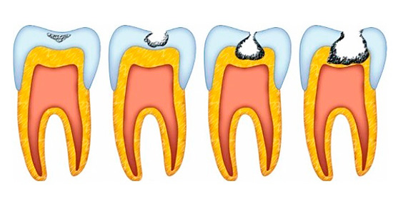 Stadia van cariës - het is duidelijk dat het dentine van de tand alleen wordt aangetast na ernstige vernietiging van het glazuur