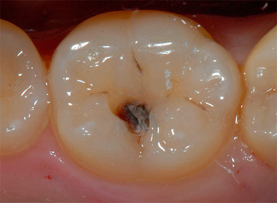 تسوس الأسنان دنين هو تدمير لا رجعة فيه من الأسنان ، وهذا هو ، الجزء المدمر يجب استبداله بملء