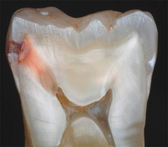 Die Inzision des kariesbefallenen Zahnes zeigt deutlich, dass die Infektion tief in das Dentin bis in die Pulpa selbst eingedrungen ist.
