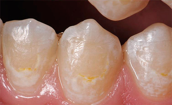 충치가 발달 초기 단계에 있고 치아 법랑질에만 영향을 미친 경우, 치료는 보수적 인 방법으로 수행 할 수 있습니다.