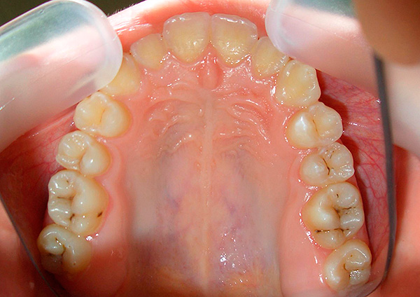 मौखिक स्वच्छता की अनुपस्थिति में, क्षय के साथ दांतों को गंभीर क्षति का खतरा बहुत अधिक है, न केवल तामचीनी बल्कि अंतर्निहित ऊतक भी प्रभावित होगा।