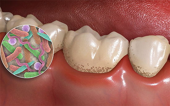 Bakterien in Plaque bilden organische Säuren, die zur Demineralisierung von Zahnschmelz beitragen.