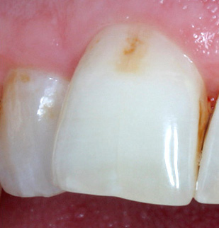 Die Farbe des kariesbefallenen Zahnschmelzes kann durch die Pigmentierung mit verschiedenen Farbstoffen allmählich braun werden.