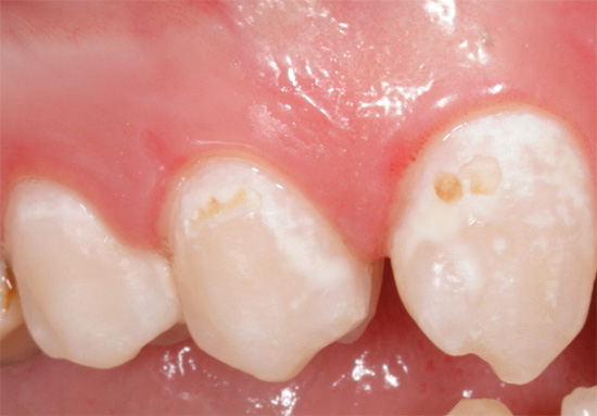 The photo shows an example of caries in the stage of the so-called white (chalk) spot