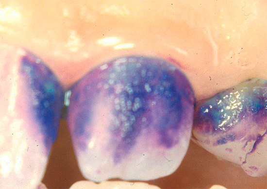 Les caries conduisent au fait que l'émail des dents devient poreux et se colore facilement avec divers colorants organiques, en particulier le bleu de méthylène.