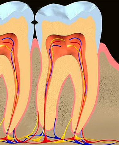A imagem mostra danos ao esmalte durante a cárie na superfície de contato dos dentes.