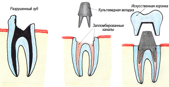An example of tooth restoration using a heart shaped tab and crown