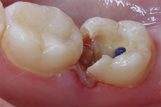 Foto de un diente fuertemente destruido por caries antes de la instalación de un relleno.