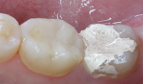 The same tooth with a temporary filling