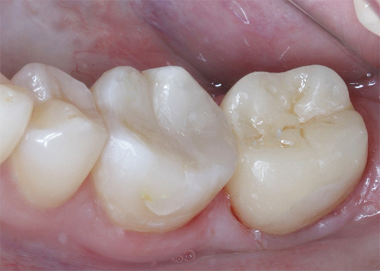 Και έτσι φαίνεται σαν ήδη σφραγισμένο δόντι μετά τη θεραπεία.