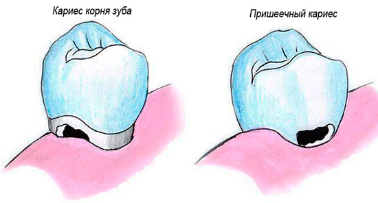 Cervicale cariës en wortel verschillen enigszins in hun locatie op de tand