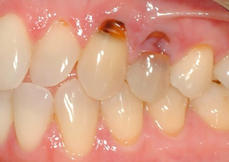 ภาพแสดงตัวอย่างของฟันผุ