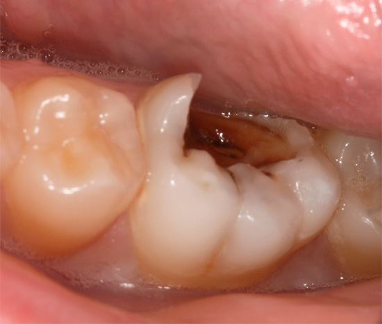 Ein vernachlässigter Kariesprozess, bei dem ein bedeutender Teil eines Zahnes zerstört wird, kann auch Wurzelkaries verursachen.