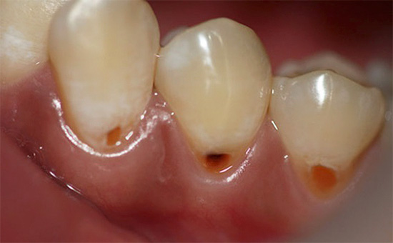 Carious process in the root of a tooth can take a long time unnoticed until it manifests itself as cervical defects.