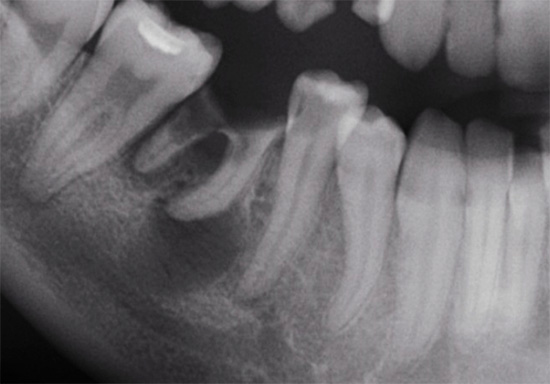 Röntgenaufnahme der Zähne: Der verdunkelnde Bereich ist an der Wurzel eines der Zähne erkennbar