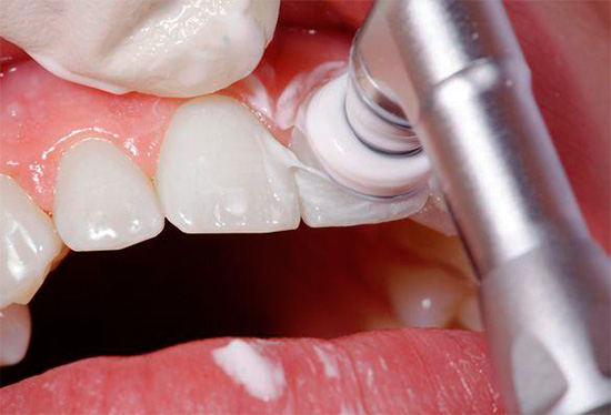 في بعض الأحيان ، يلزم النظافة الفموية المهنية قبل علاج تسوس الأسنان.
