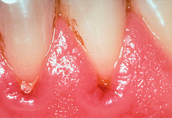 Manchmal äußert sich die Pathologie in fortgeschrittenen Fällen als Läsionen des Zahnfleisches und der sichtbaren Bereiche des Zahnschmelzes.