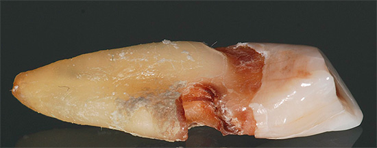 Зъб с коренозен кариес