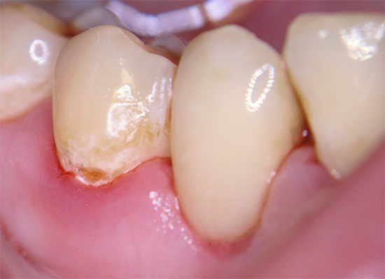 Das Foto zeigt ein Beispiel für Gebärmutterhalskaries - es befindet sich über dem Zahnfleisch