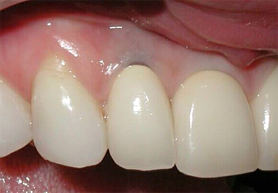 Cu dezvoltarea pe termen lung a cariilor sub gingie, rădăcina poate fi atât de sever afectată încât dintele trebuie îndepărtat.