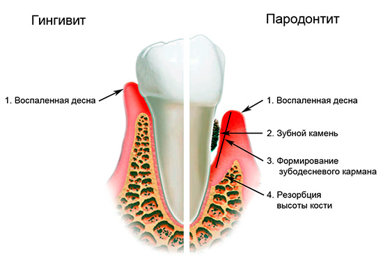 Zahnfleischkaries ist oft mit verschiedenen Komplikationen verbunden, von denen eine Parodontitis ist ...