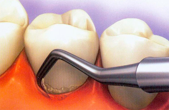 Tasche alimentari e microrganismi cariogeni possono accumularsi nelle tasche tra la gomma e il dente.