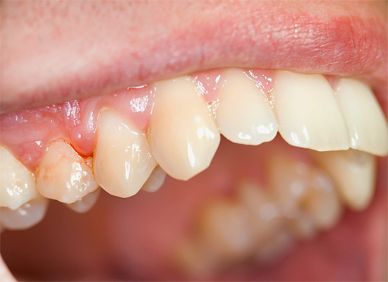 Often, patients complain not even of a tooth, but of pain in the gums