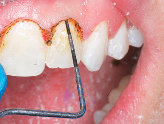 When treating caries located under the gum, excision of the soft tissues adjacent to the tooth is often required.
