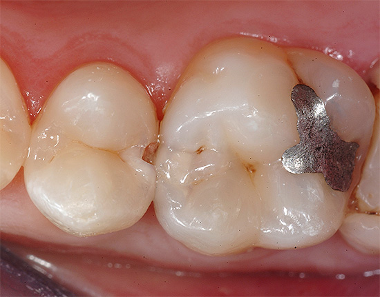 ข้อเสียที่สำคัญของการอุดฟันมัลกัมเป็นเนื้อหาที่มีความเข้มข้นสูงในปรอท